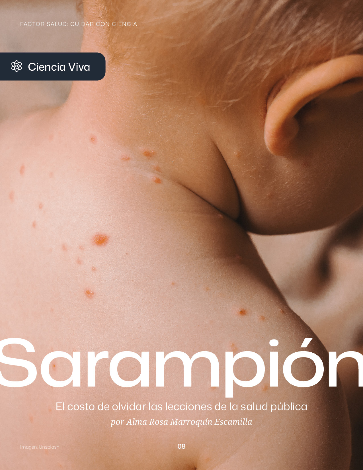 Sarampión